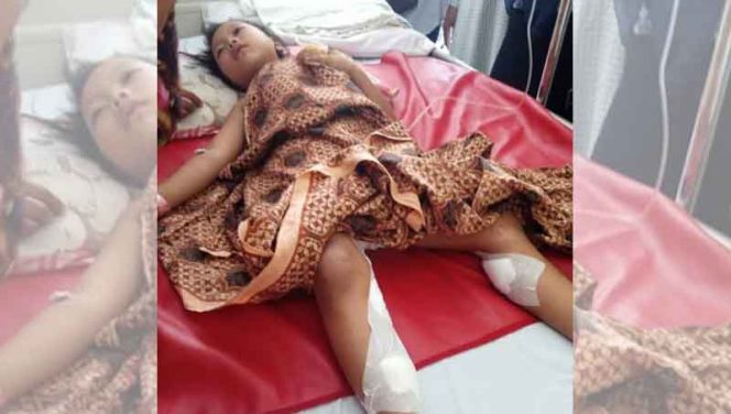 
					Elis Susilawati bocah 6 tahun yang digigit monyet liar, kini kondisinya sudah membaik.